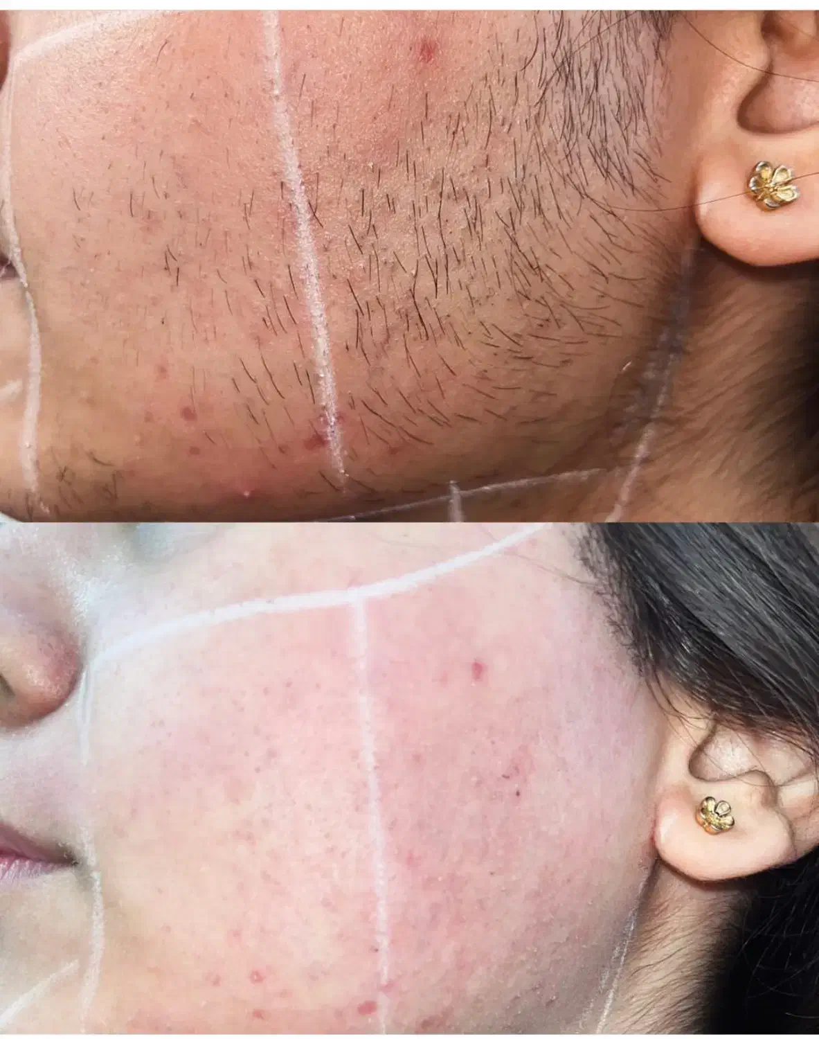 لیزر موهای زائد|خدمات آرایشگری و زیبایی|شهرضا, |دیوار