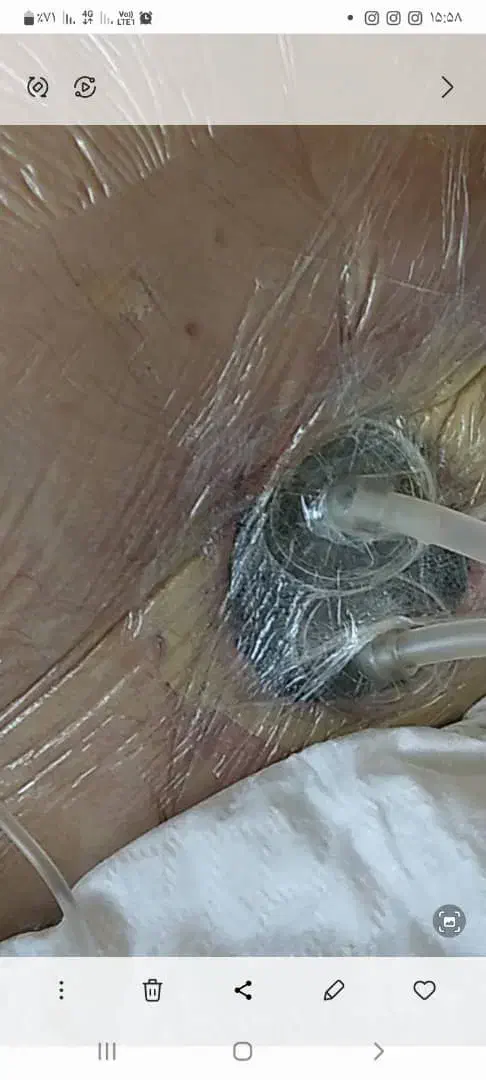 درمان انواع زخم ها با روش های بروز پزشکی|خدمات آرایشگری و زیبایی|تبریز, |دیوار