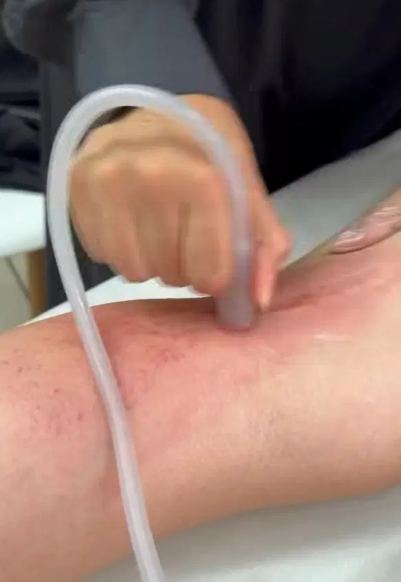 اولین بار در کرمانشاه درمان تضمینی ترک پوستی|خدمات زیبایی و سلامت|کرمانشاه, |دیوار