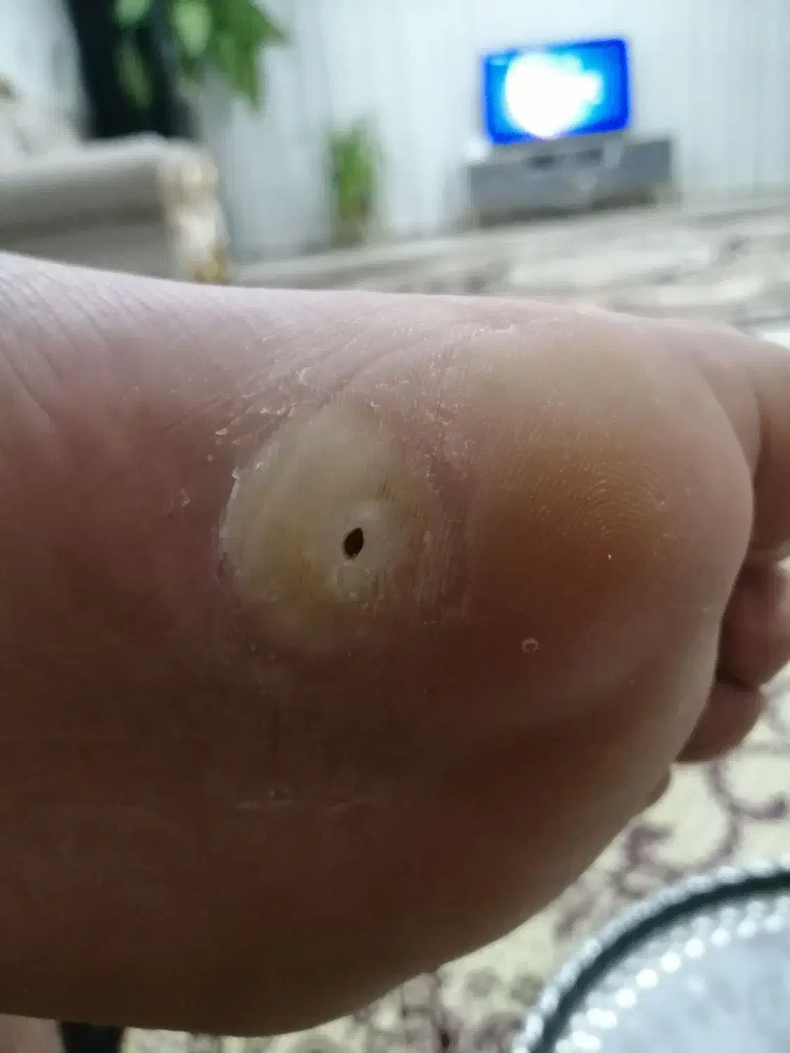 برداشتن خال زیگیل ومیخچه دست پابامحلول گیاهی|خدمات آرایشگری و زیبایی|نیشابور, بنیاد شهید|دیوار