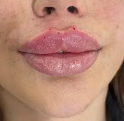 جشنواره تزریق ژل و بوتاکس زیر قیمت همه جا|خدمات زیبایی و سلامت|تهران, ائمه اطهار|دیوار