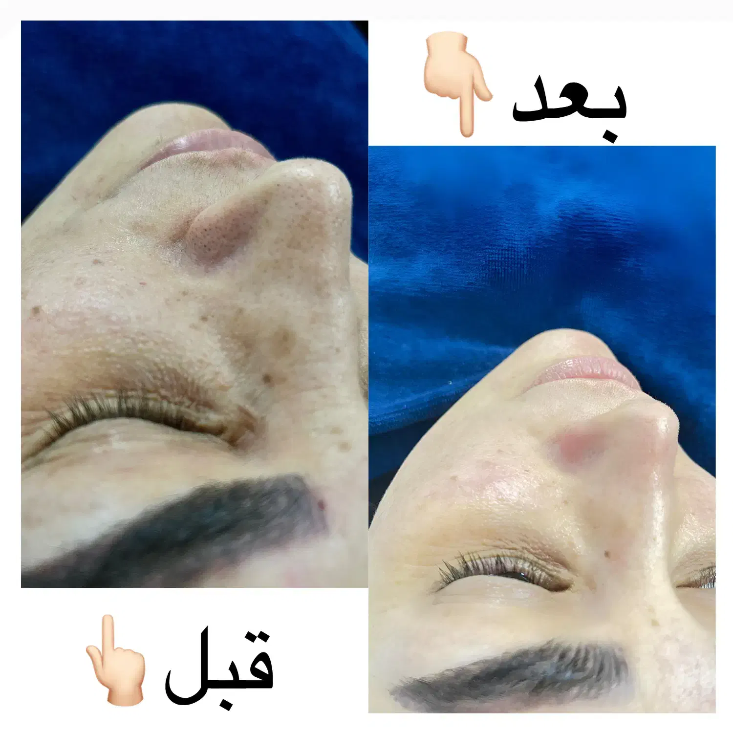 پاکسازی پوست به صورت حرفه ای فقط ۴۰۰ت|خدمات آرایشگری و زیبایی|قائمشهر, |دیوار