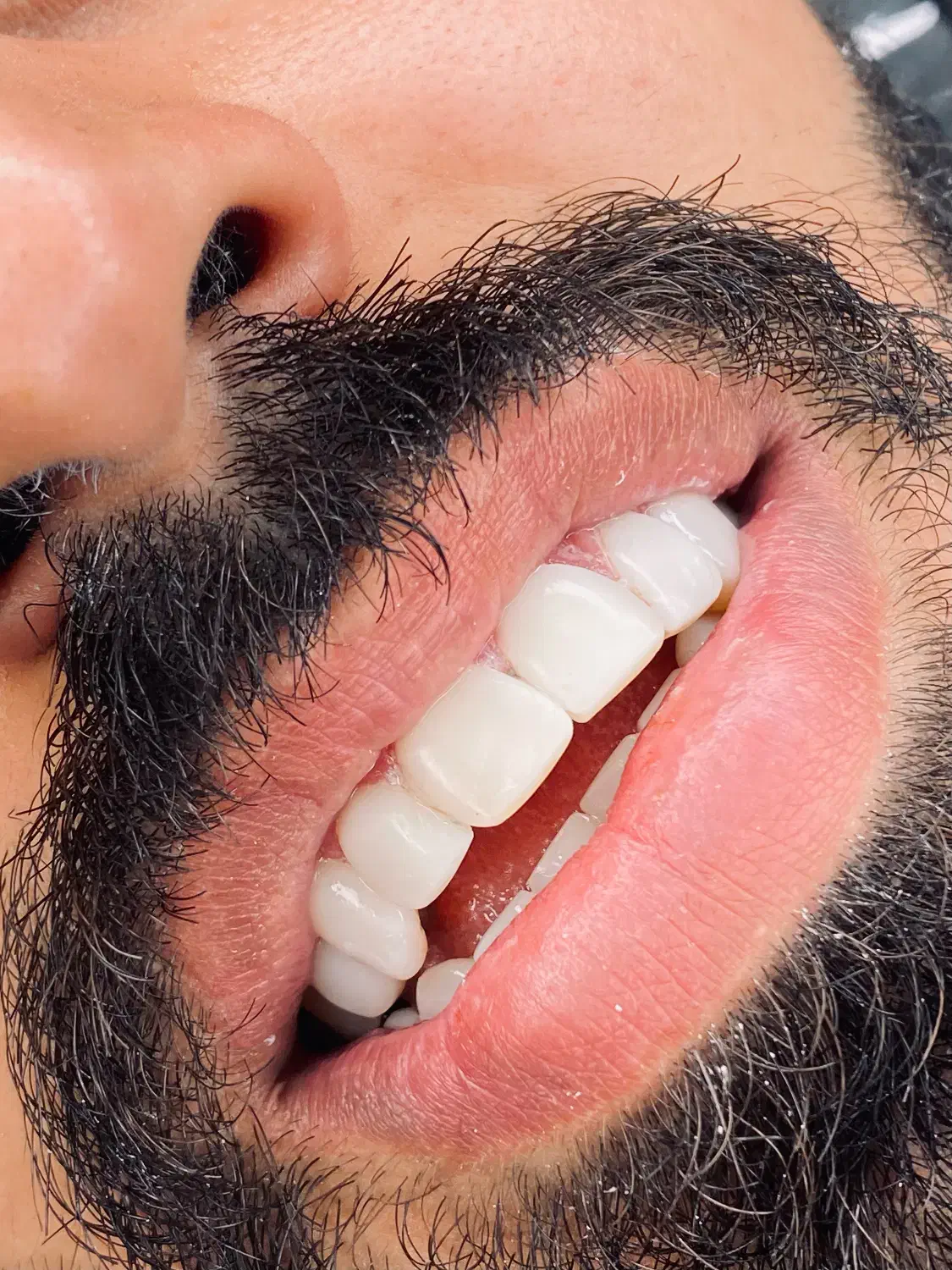 تخفیف ویژه کامپوزیت به مدت یک هفته|خدمات آرایشگری و زیبایی|اهواز, زیباشهر|دیوار
