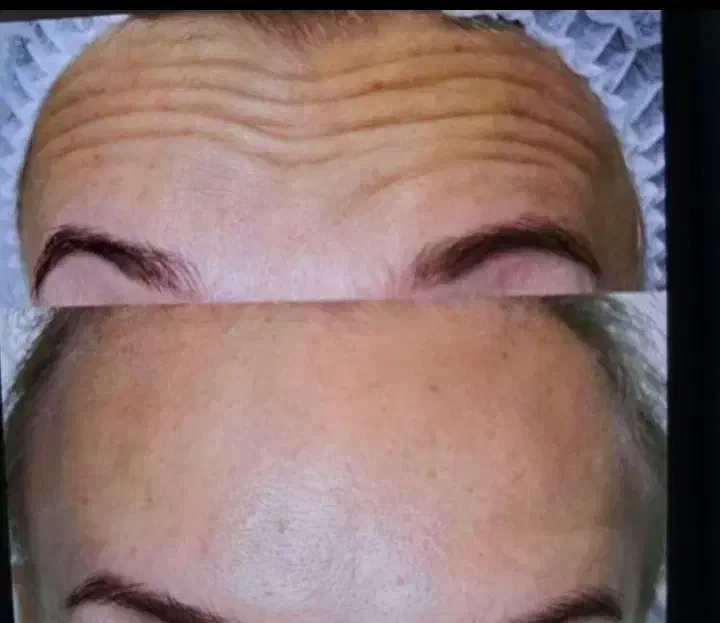 ، تزریق ژل فیلر بوتاکس مزو فیلر بادی..|خدمات آرایشگری و زیبایی|شیراز, فضل‌آباد|دیوار