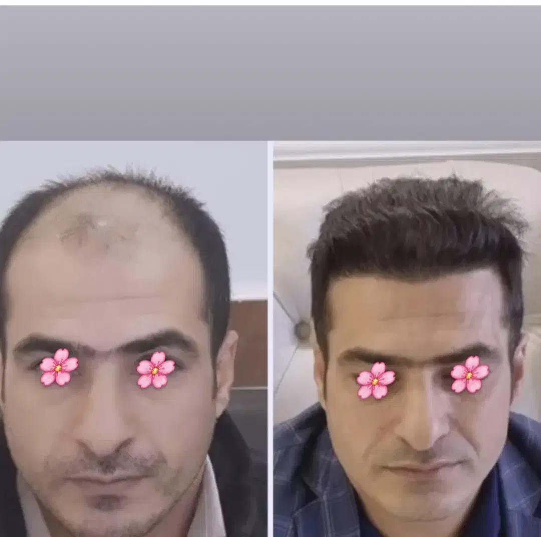 کاشت مو فقط 6 میلیون تومان به مدت محدود|خدمات آرایشگری و زیبایی|شیراز, زرگری|دیوار