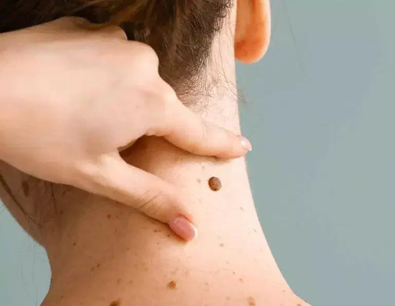 دستگاه خال برداری وزگیل برداری حتی جا های حساس|آرایشی، بهداشتی، درمانی|آبادان, |دیوار