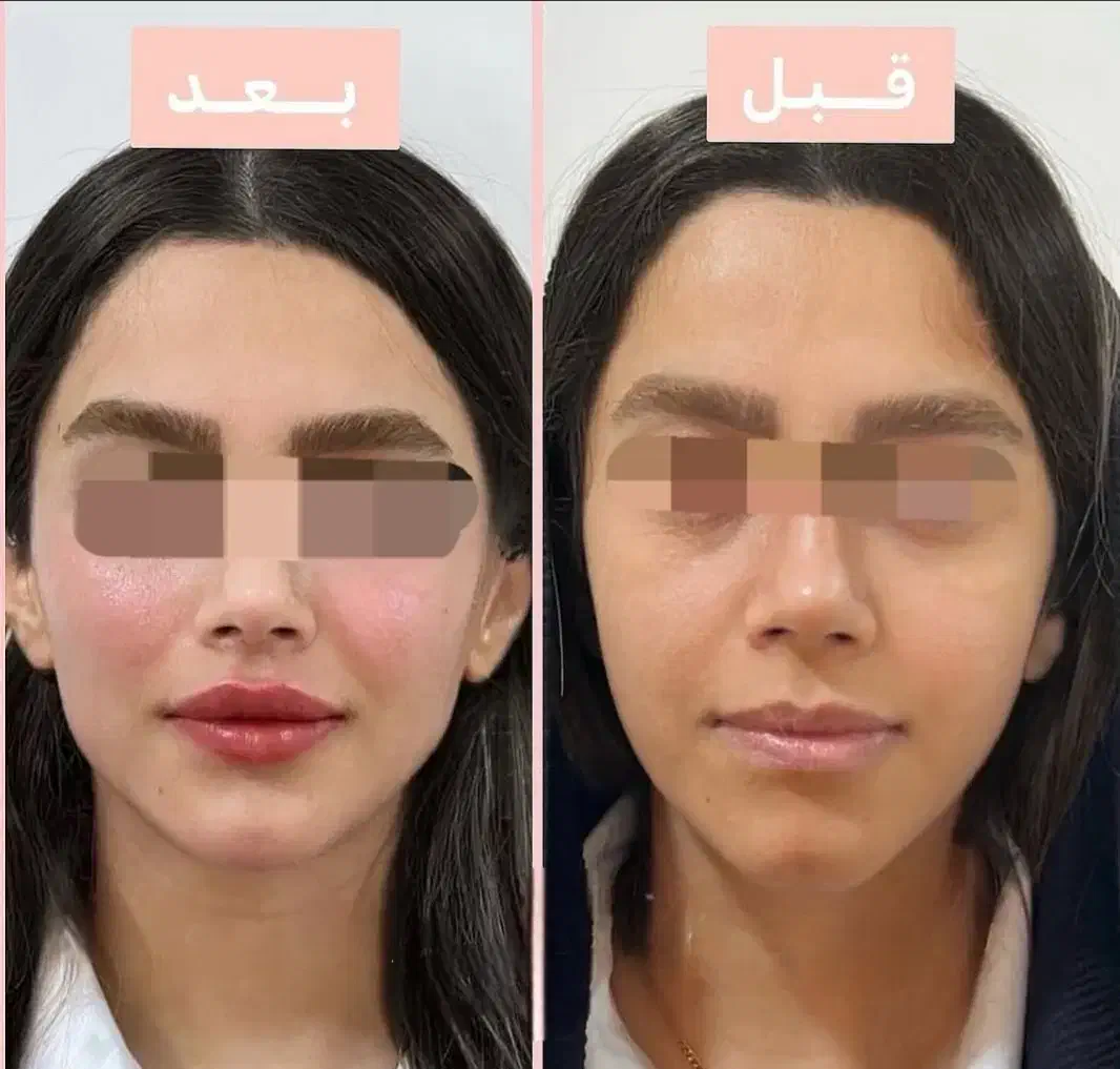 تزریق چربی ژل بوتاکس|خدمات آرایشگری و زیبایی|خرم‌آباد, |دیوار