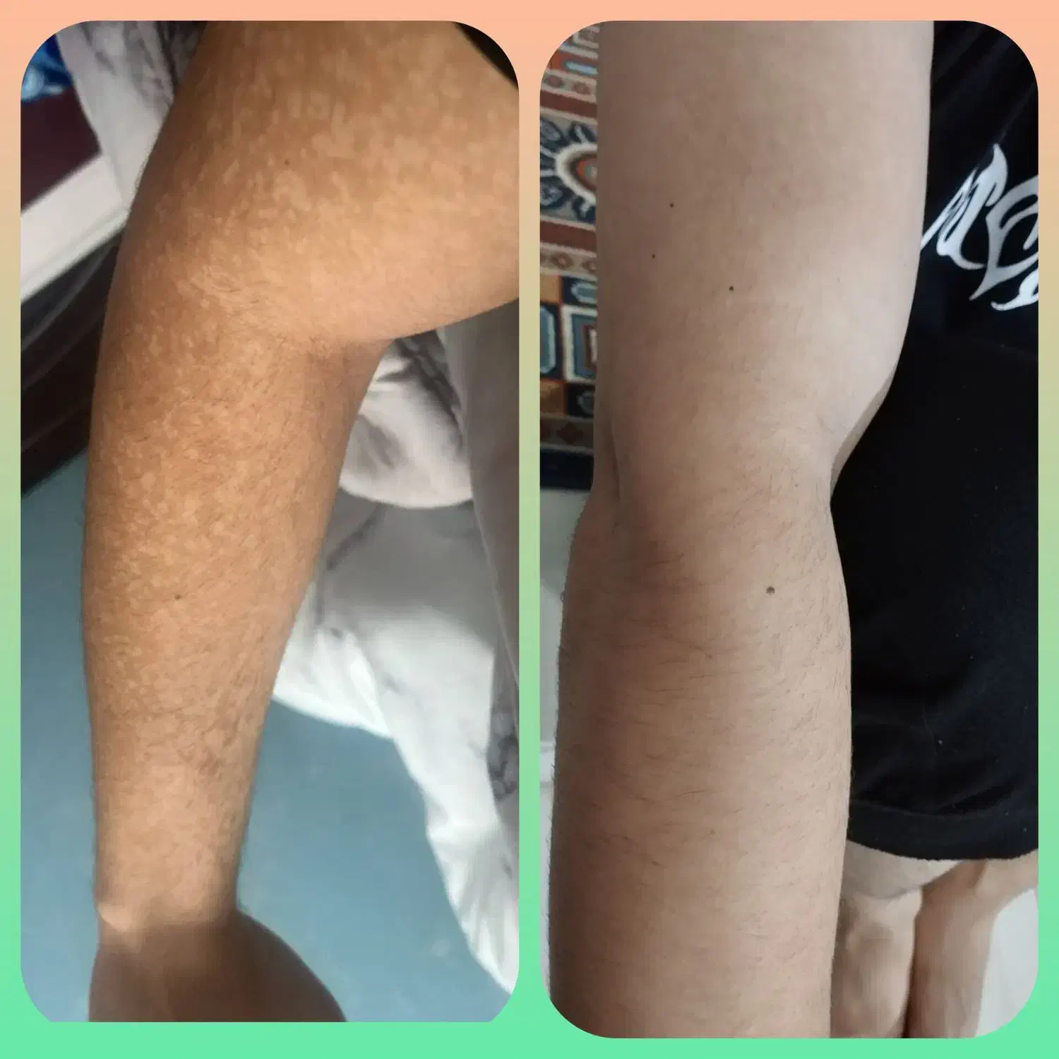 با لک ها و جوش های مزاحم خود خدافظی کنید|آرایشی، بهداشتی، درمانی|اهواز, غیزانیه|دیوار