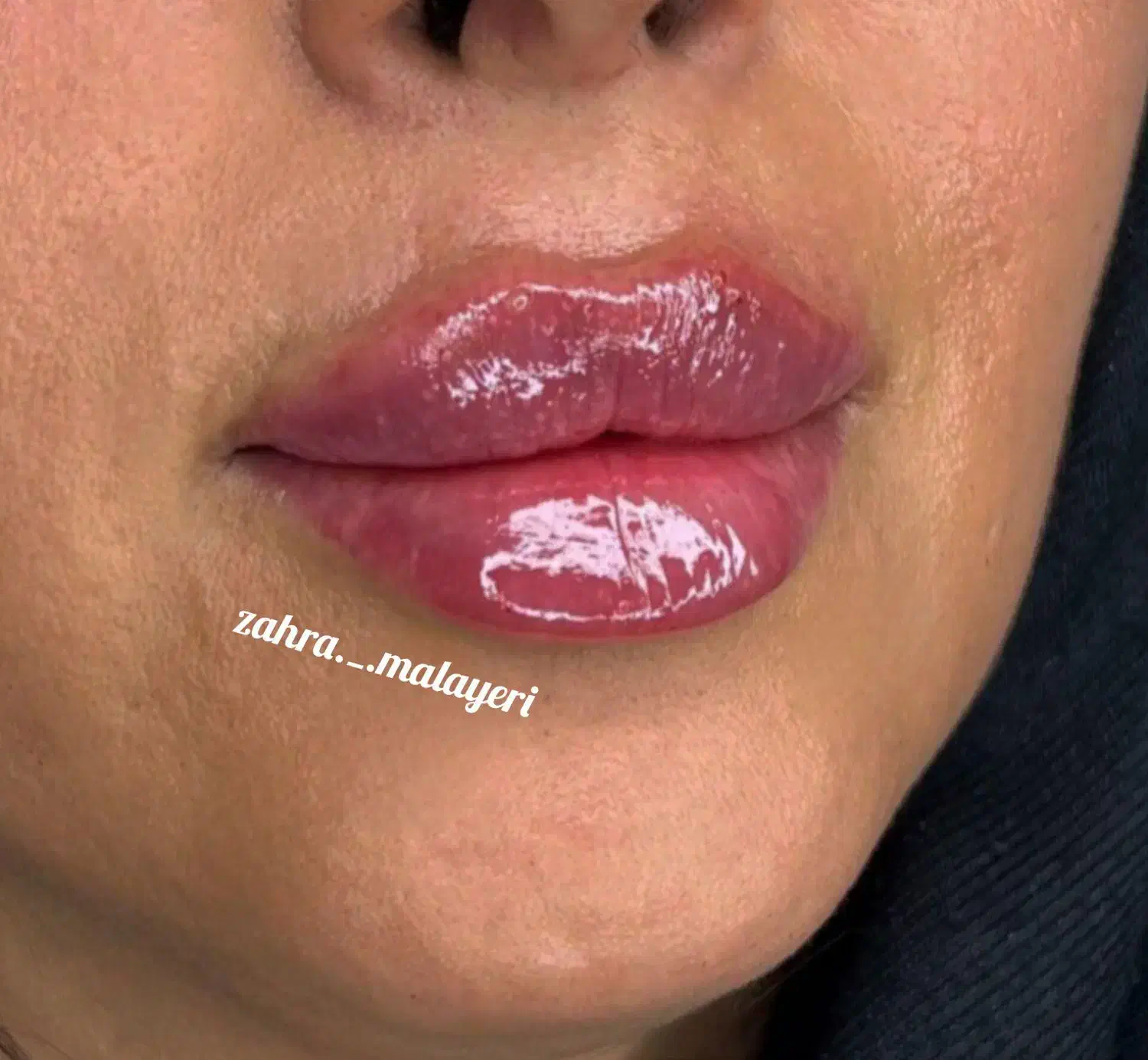 تزریق ژل فیلر تضمینی بوتاکس پرسینگ چاله گونه|خدمات آرایشگری و زیبایی|قم, نیروگاه|دیوار