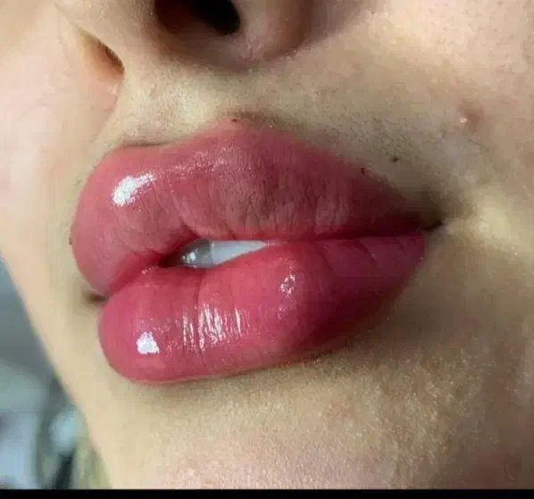 تزریق آموزش ژل بوتاکس چربی|خدمات آرایشگری و زیبایی|صدرا-فارس, فاز ۱|دیوار