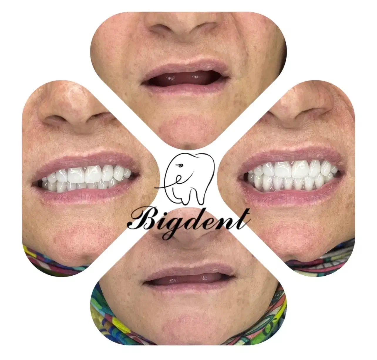 دندان مصنوعی تخفیف تا شب یلدا برای ۵ نفر قیمت ویژه|آرایشی، بهداشتی، درمانی|تبریز, |دیوار