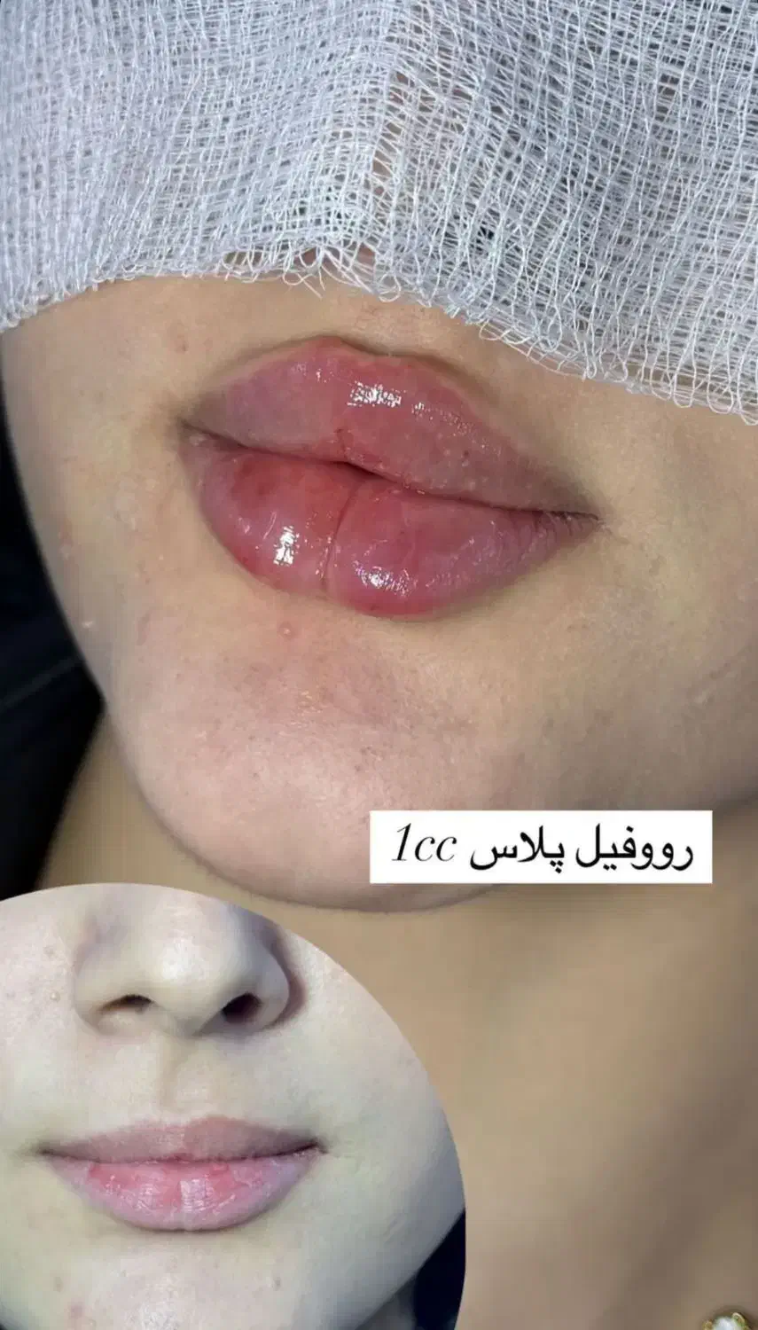 آف یلدایی تزریق ژل و بوتاکس|خدمات آرایشگری و زیبایی|ملایر, |دیوار