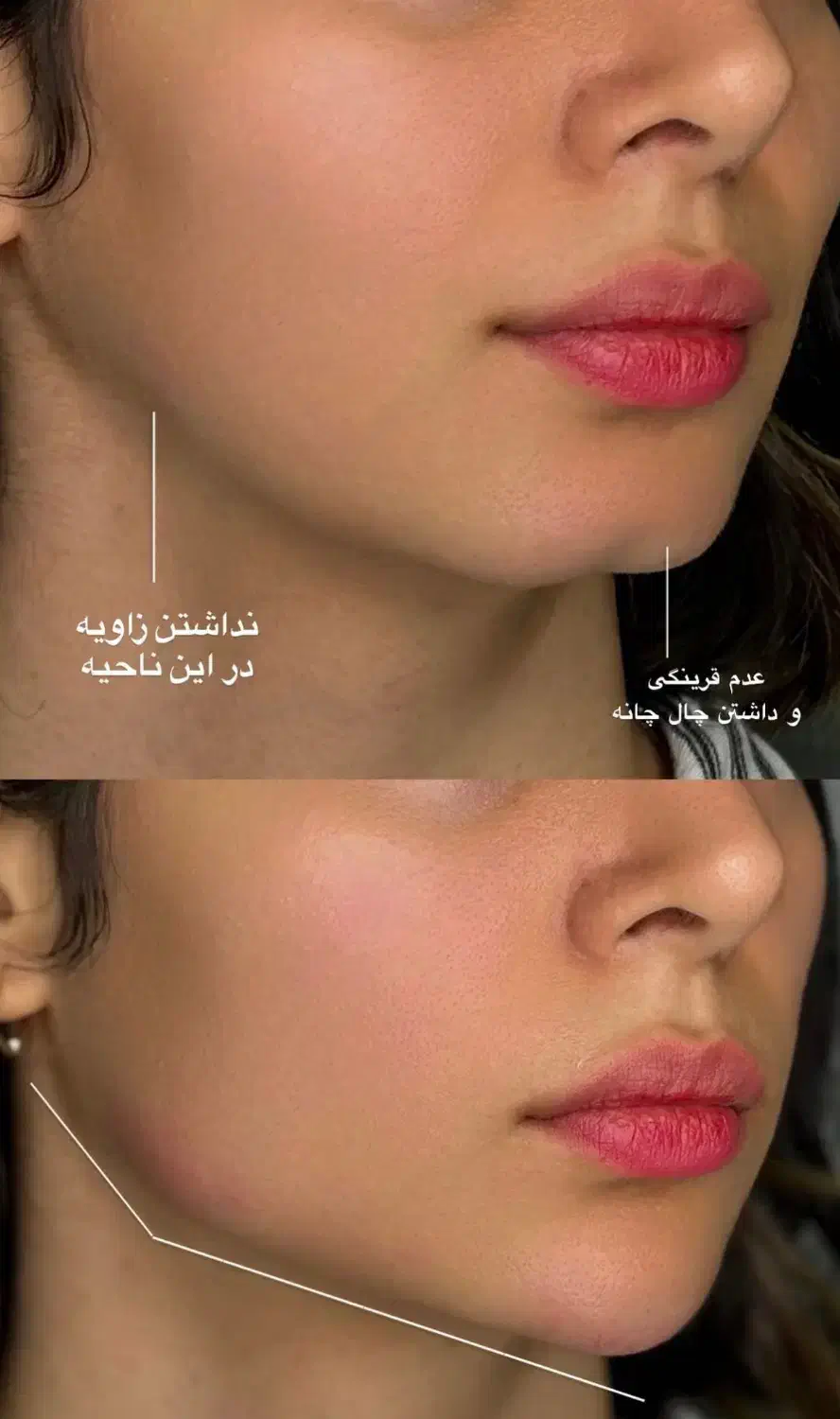 تزریق ژل لب بوتاکس مزو نخ آنزیم لیفت پکیج۱۰ سی سی|خدمات آرایشگری و زیبایی|تهران, مرزداران|دیوار