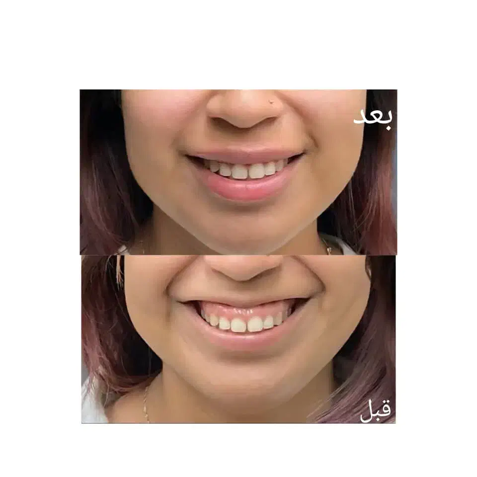 بوتاکس و ژل|خدمات آرایشگری و زیبایی|تهران, مطهری|دیوار