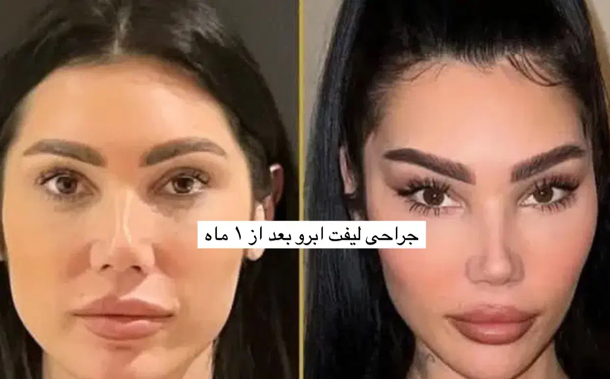 جراحی لیفت ابرو،دایرکت ابرو،لیفت شقیق ،پیشانی|خدمات آرایشگری و زیبایی|تهران, پاسداران|دیوار