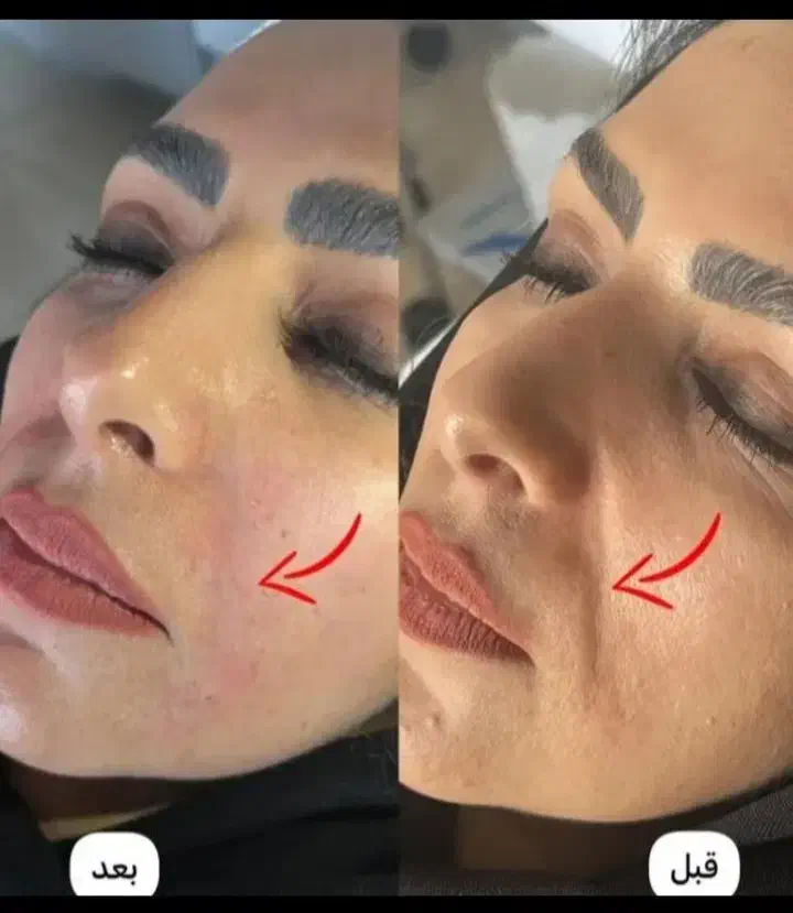 آموزش ژل و بوتاکس نیدلینگ|خدمات آموزشی|رفسنجان, |دیوار