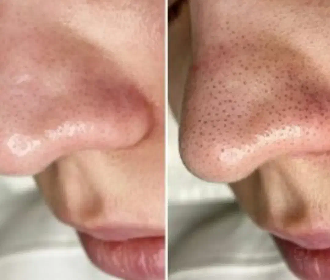 فیشیال و پاکسازی وجوانسازی پوست|خدمات آرایشگری و زیبایی|خوی, |دیوار