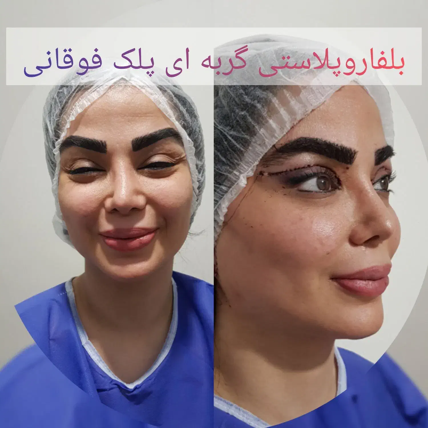 جشنواره پائیزی جراحی پلک.شقیقه.ابرو.سانترال لب.|خدمات آرایشگری و زیبایی|زاهدان, |دیوار