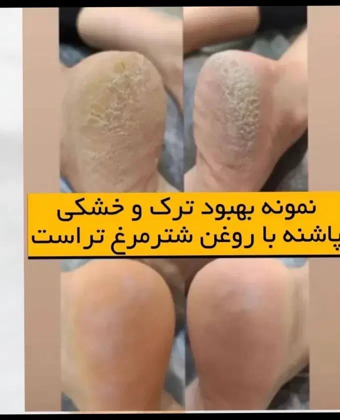 کرم ترکپا وروغن شتر مرغ|آرایشی، بهداشتی، درمانی|تربت جام, جامی|دیوار