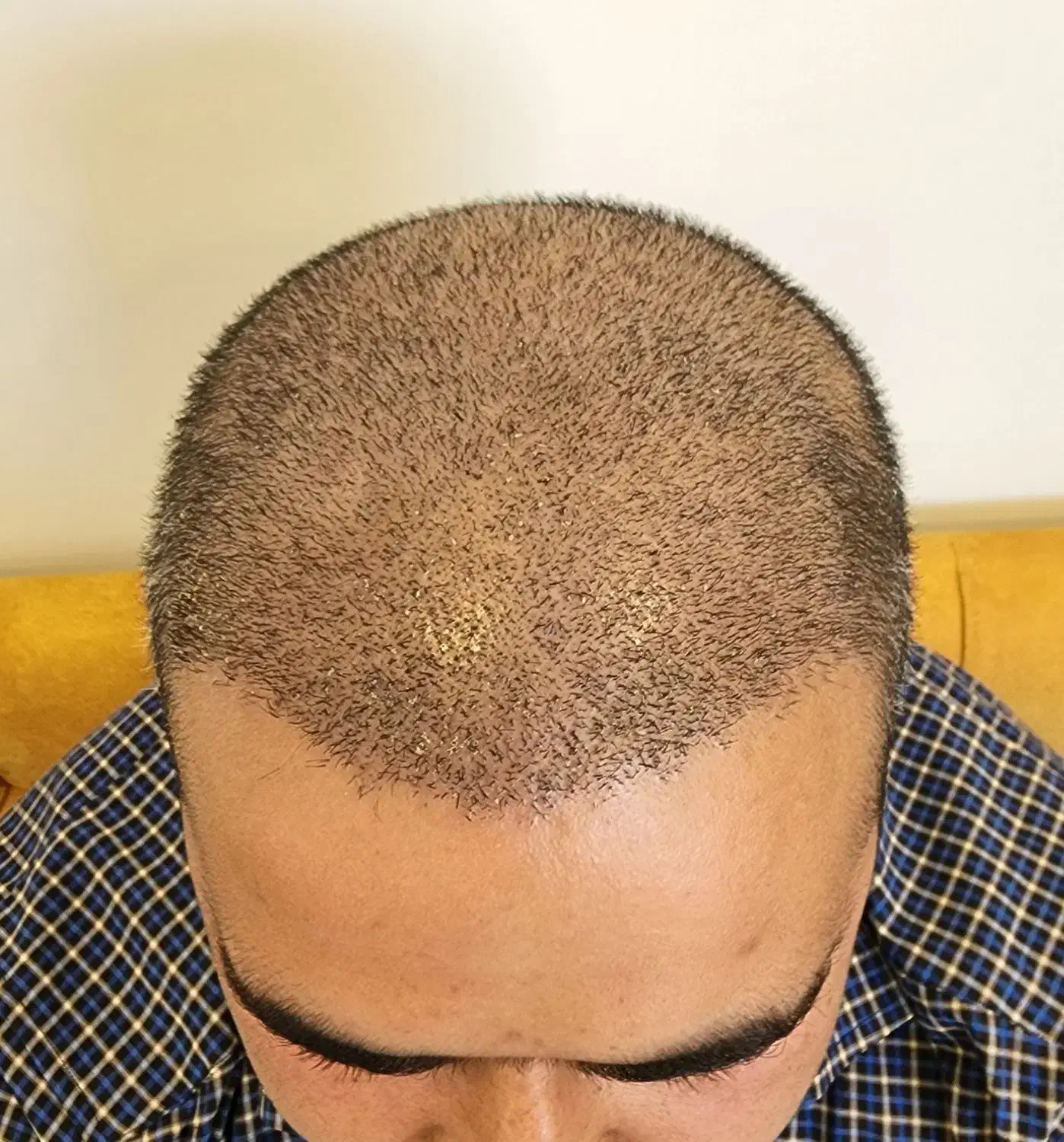 کاشت مو تخصصی|خدمات آرایشگری و زیبایی|اسکو, |دیوار