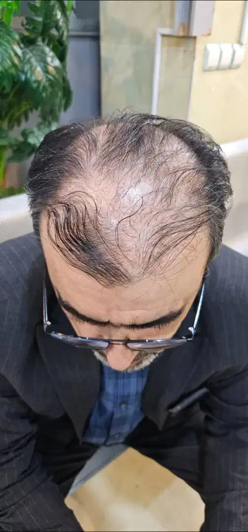 کاشت مو و ابرو با جدید ترین دستگاه های روز دنیا|خدمات آرایشگری و زیبایی|یاسوج, |دیوار