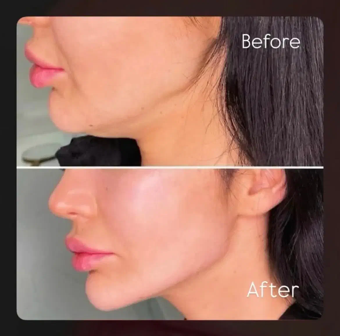 جشنواره تخفیفی ژل و بوتاکس/وام/اقساطی|خدمات آرایشگری و زیبایی|ساری, |دیوار