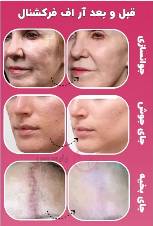 هایفوتراپی و آر اف ۷بعدی اولترا|خدمات آرایشگری و زیبایی|قم, زینبیه|دیوار