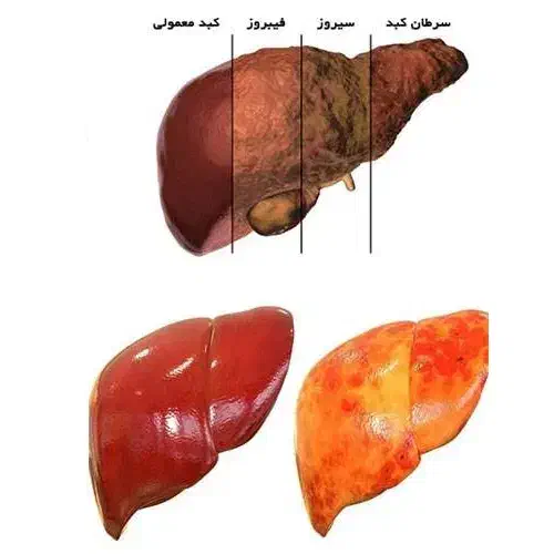کبدچرب داری درمان نکردی ها|آرایشی، بهداشتی، درمانی|گرگان, |دیوار