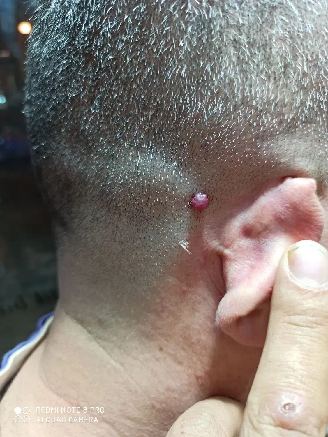 برداشت خال بالیزر بدون خون ریزی در یک جلسه|خدمات آرایشگری و زیبایی|ایلام, |دیوار