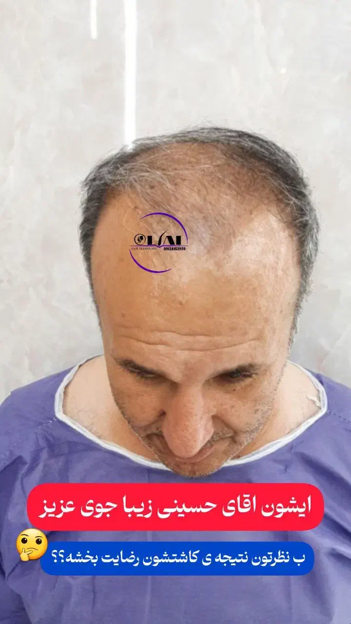 کاشت مو و ابرو|خدمات آرایشگری و زیبایی|قم, پامنار|دیوار