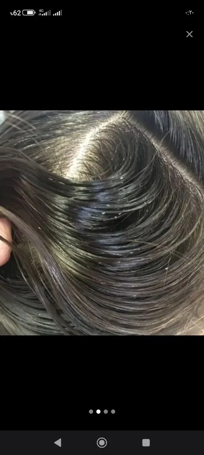 پایان کابوس شپش سر|آرایشی، بهداشتی، درمانی|آزادشهر, |دیوار