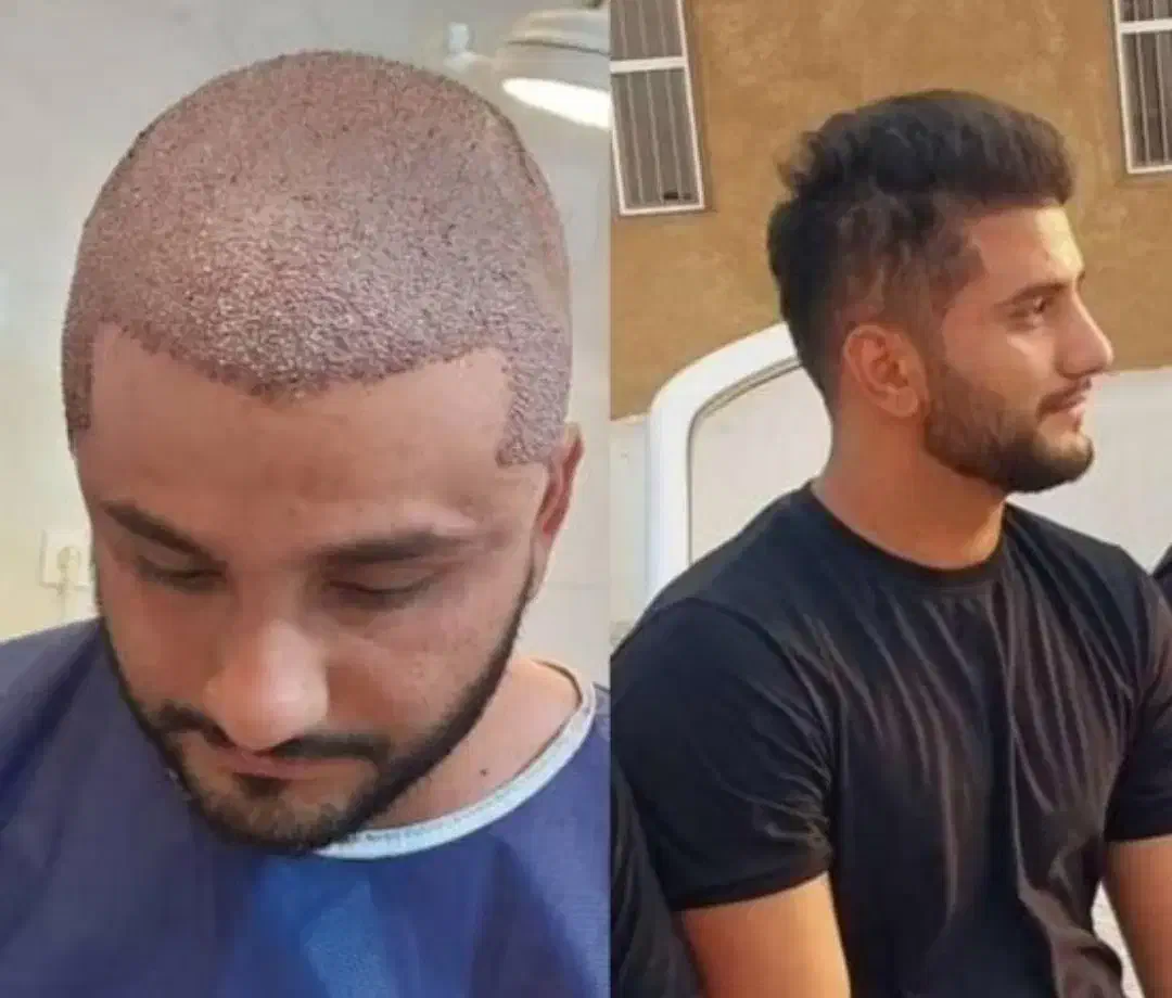 کاشت مو و ابروی طبیعی مزو و پی آرپی جلوگیری ریش مو|خدمات آرایشگری و زیبایی|تبریز, |دیوار