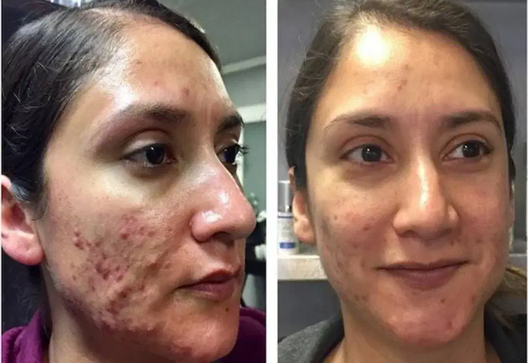 پاکسازی صورت درماپلینگ بابهترین مواد|خدمات آرایشگری و زیبایی|بیرجند, |دیوار