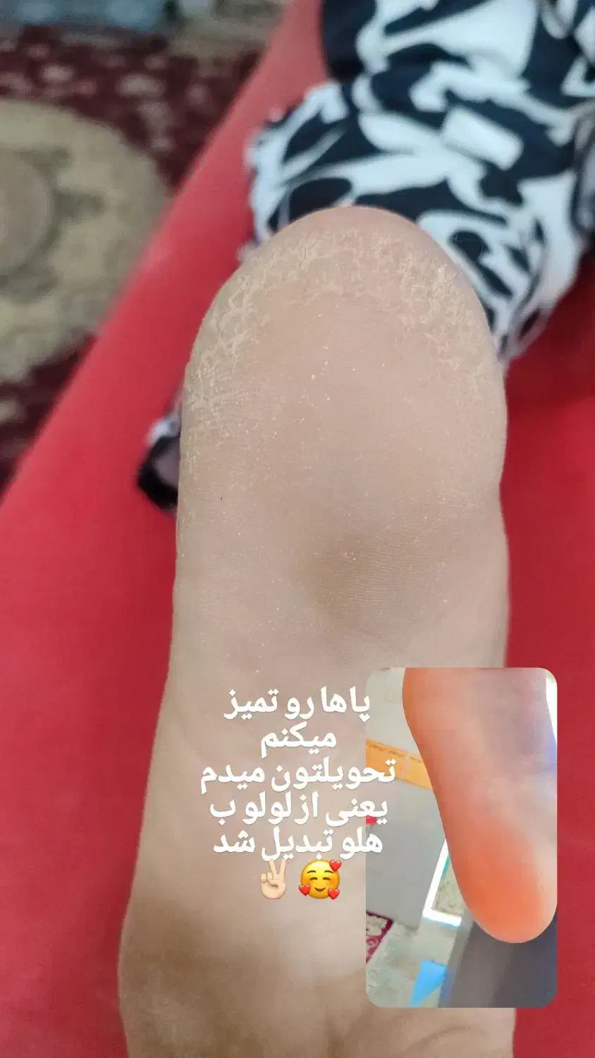 پدیکور و رفع سیاهی قوزک پا و جوانسازی دست|خدمات آرایشگری و زیبایی|برازجان, |دیوار