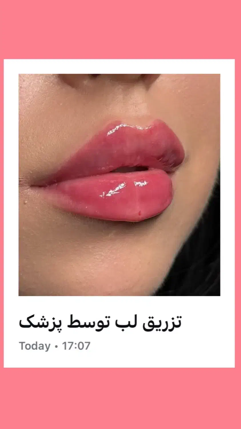 تخفیفات طلایی/ژل لب/ بوتاکس/ گونه/ فول فیس خط خنده|خدمات آرایشگری و زیبایی|مشهد, دانشجو|دیوار