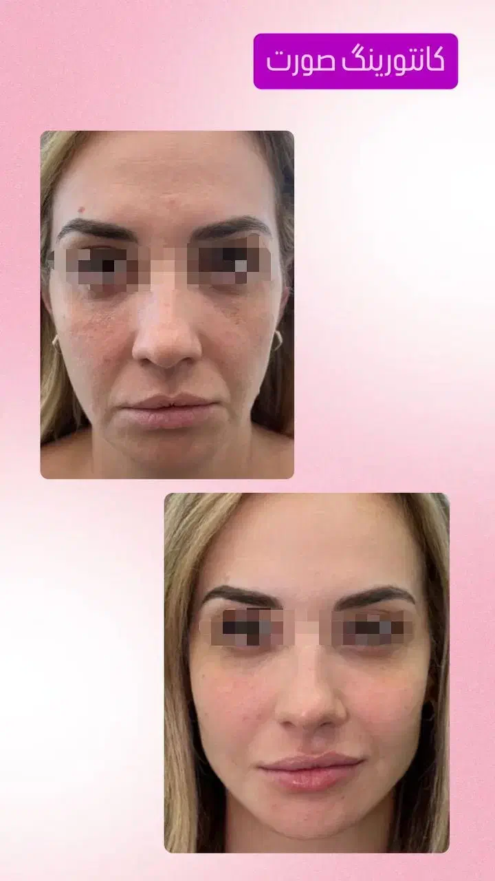 تزریق ژل،لیزر،بوتاکس|خدمات آرایشگری و زیبایی|تهران, یافت‌آباد|دیوار