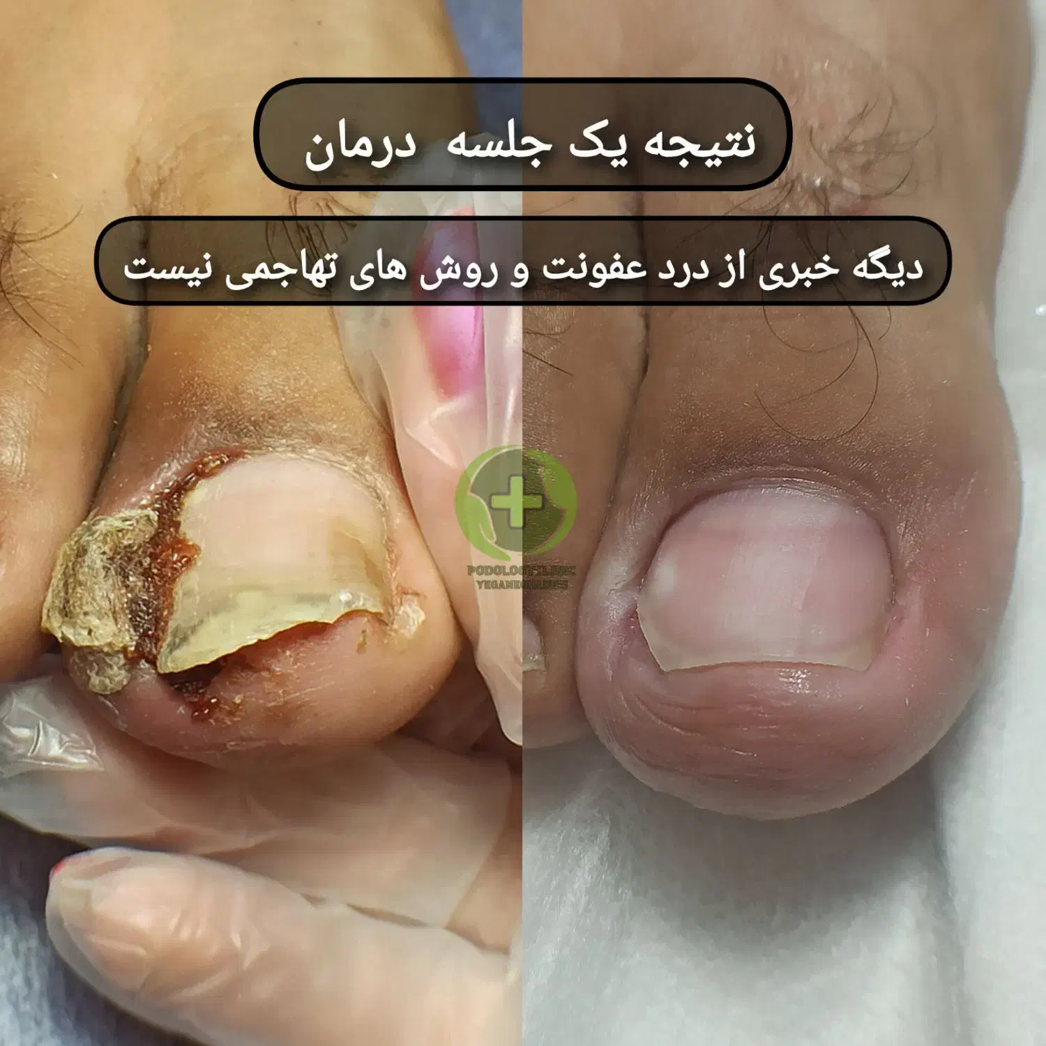 درمان بیماری های ناخن بدون جراحی درکلینیک|خدمات آرایشگری و زیبایی|قرچک, مهدیه|دیوار