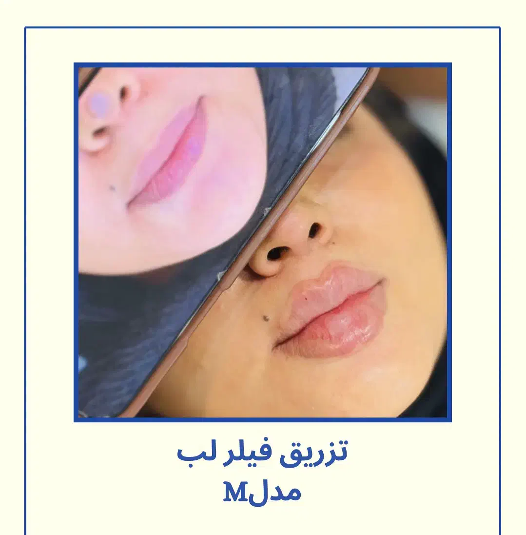 فیلر لب روسی -زاویه سازی -بوتاکس-پی ار پی -مزو|خدمات آرایشگری و زیبایی|تهران, دریا|دیوار