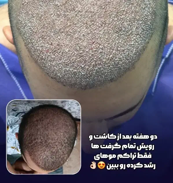 کاشت موی طبیعی|استخدام درمانی، زیبایی، بهداشتی|تهران, جردن|دیوار