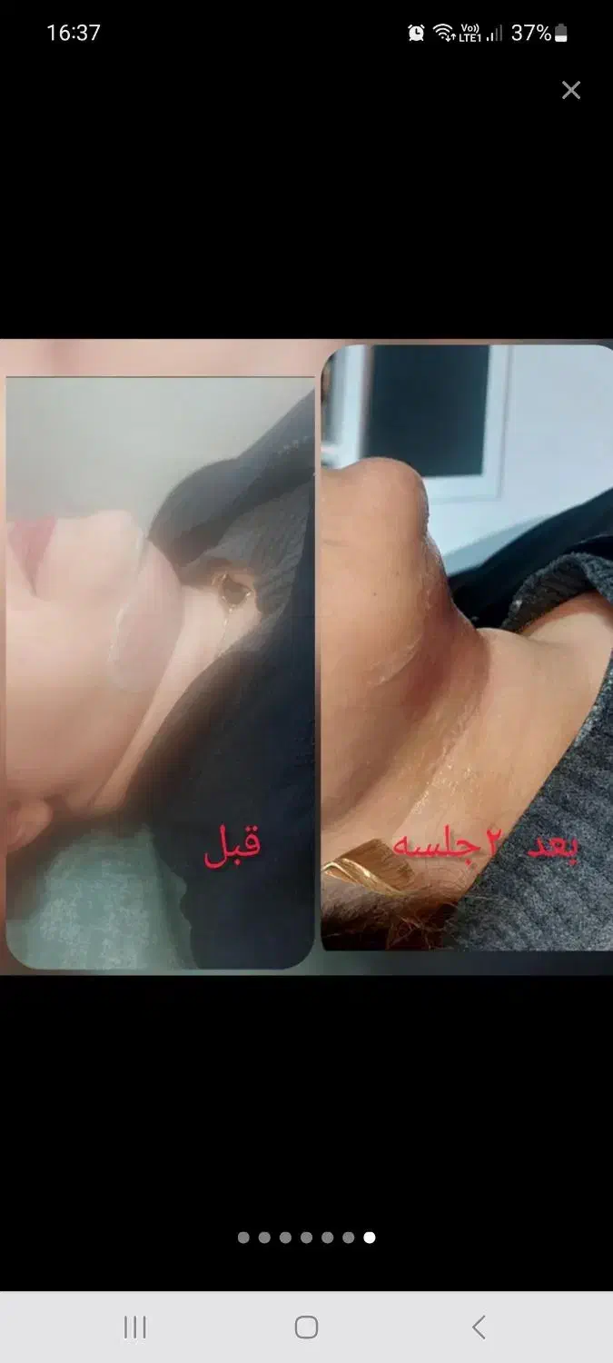 لاغری موضعی و فیشال و پلاژن تراپی|خدمات آرایشگری و زیبایی|تهران, ائمه اطهار|دیوار