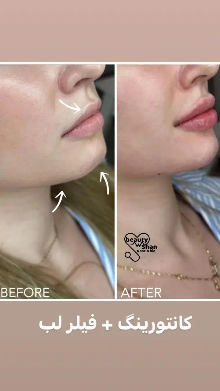 خدمات زیبایی ساکشن و تزریق فیلر های بادی|خدمات آرایشگری و زیبایی|خرمآباد, |دیوار