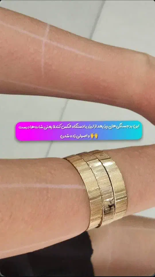 لیزر کندلا اصلی برای موهای زائد در مطب روشا|خدمات آرایشگری و زیبایی|کوهدشت, |دیوار