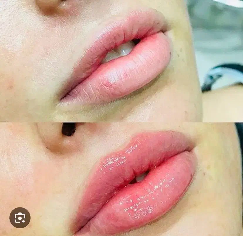 ژل و بوتاکس|خدمات آرایشگری و زیبایی|خرم‌آباد, |دیوار