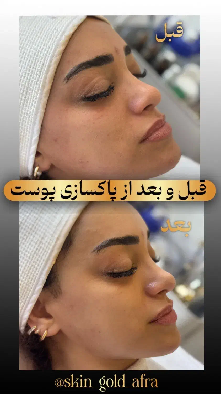 فیشال و پاکسازی پوست|خدمات آرایشگری و زیبایی|بابلسر, |دیوار