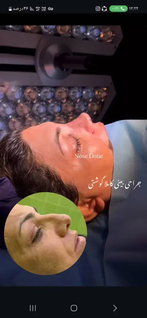 جراحی بینی با قیمت استثنایی در تهران فقط ۳۱ میلیون|خدمات آرایشگری و زیبایی|ساری, |دیوار