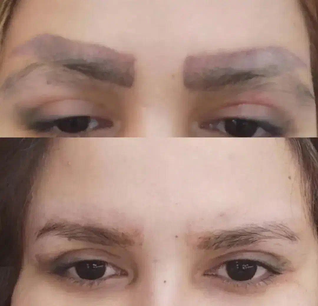 ریموو درمانی تتو های بدرنگ قدیمی|خدمات آرایشگری و زیبایی|الشتر, |دیوار