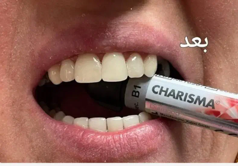 کامپوزیت دندان جشنواره ی تخفیفات تا شب یلدا|خدمات آرایشگری و زیبایی|رشت, معلم|دیوار