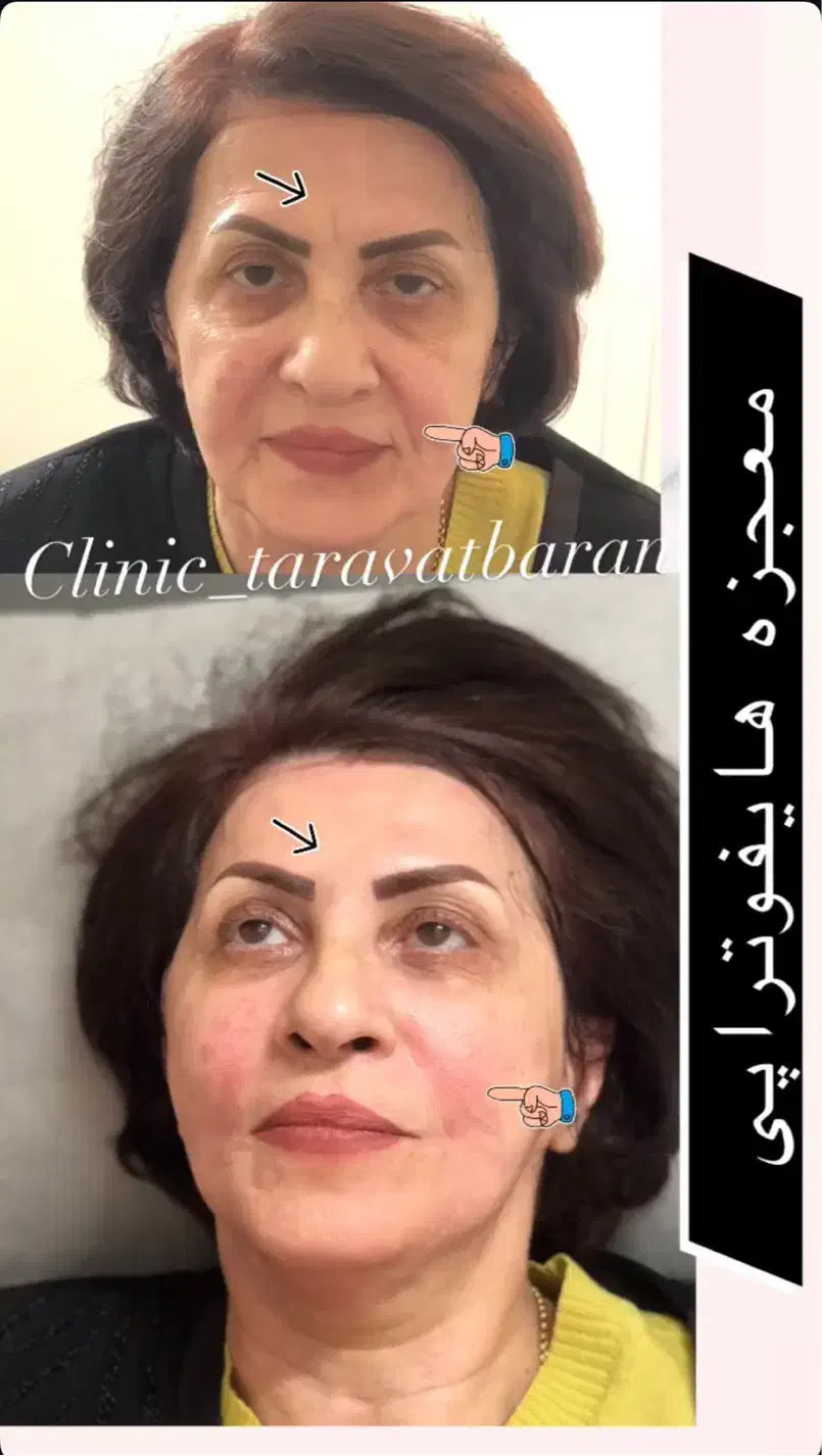 لیزر موهای زائد پی‌آر‌پی هایفو حجم‌سینه‌باسن لاغری|خدمات آرایشگری و زیبایی|تهران, صادقیه|دیوار