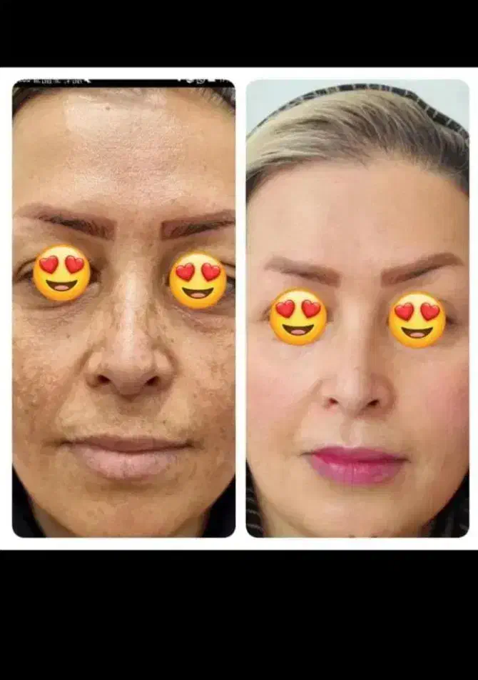 روشن کننده صورت و دست معجزه بشرط اصلی و گیاهی|آرایشی، بهداشتی، درمانی|یاسوج, |دیوار