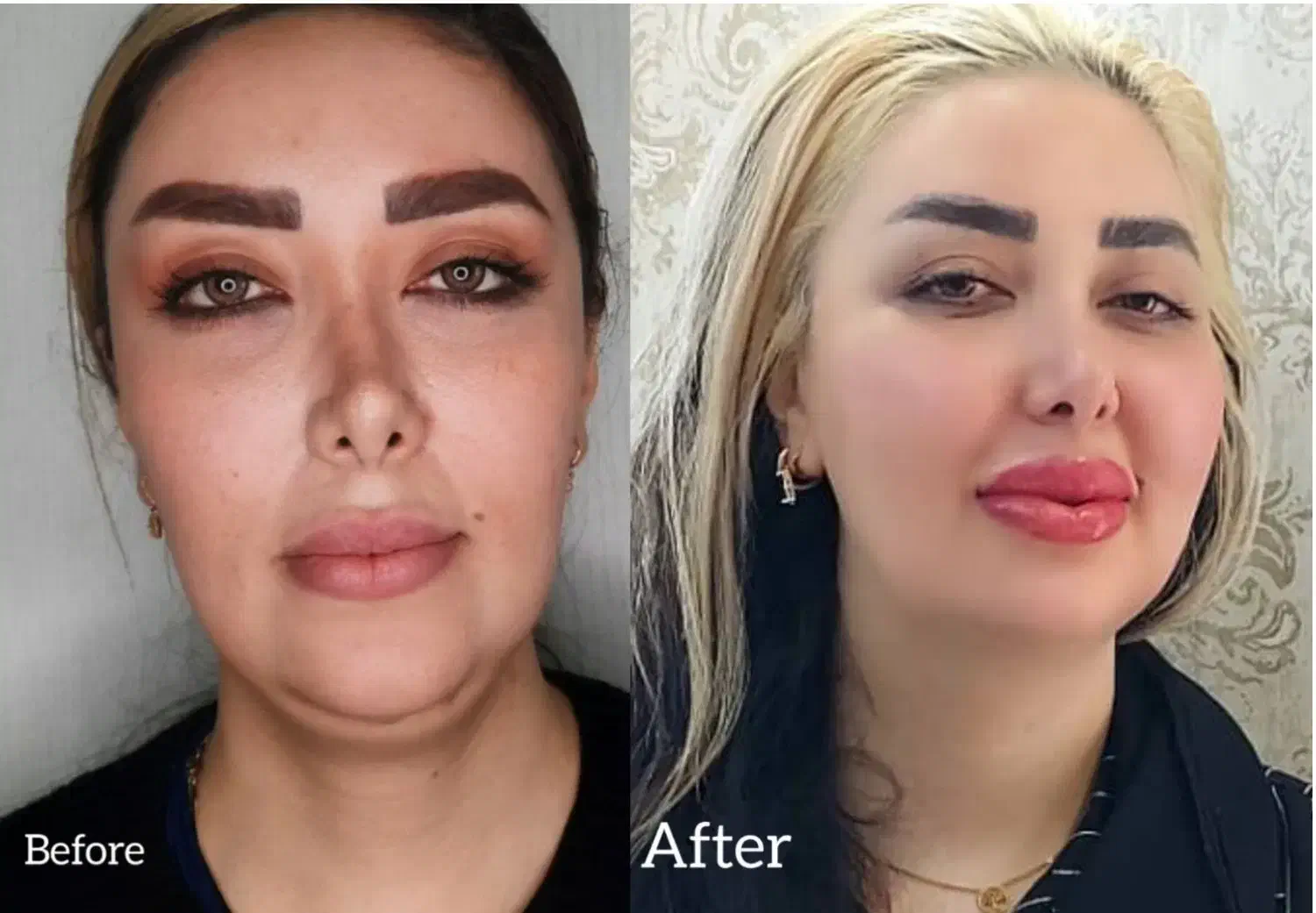 تزریق چربی|خدمات آرایشگری و زیبایی|تهران, تهرانسر مرکزی|دیوار